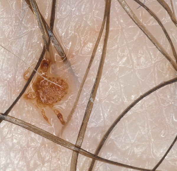 Если по утрам чешется лобок, скорее всего, у вас лобковые вши