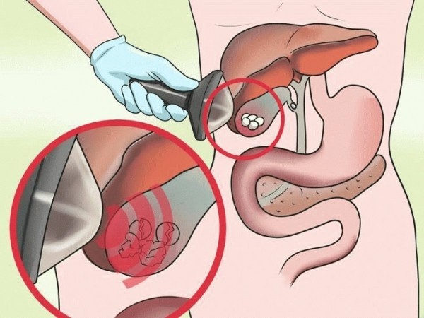 Безоперационные методы удаления камней из желчного пузыря Безоперационные методы удаления камней из желчного пузыря