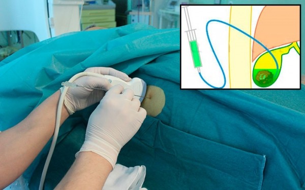 Безоперационные методы удаления камней из желчного пузыря Безоперационные методы удаления камней из желчного пузыря