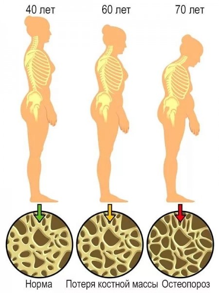 Что такое остеопороз, симптомы и причины болезни костей