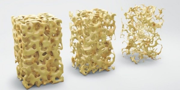 Что такое остеопороз, симптомы и причины болезни костей