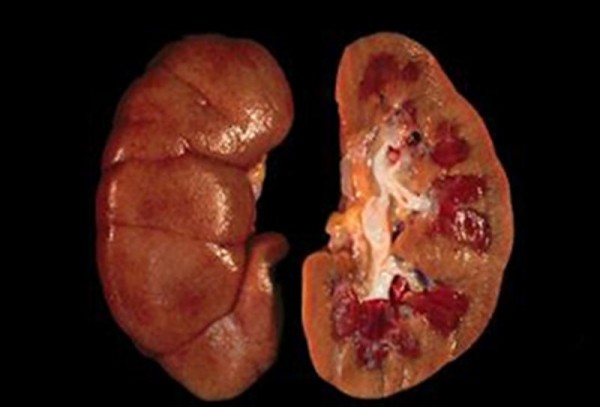 Что такое почечная недостаточность, симптомы и лечение заболевания Что такое почечная недостаточность, симптомы и лечение заболевания