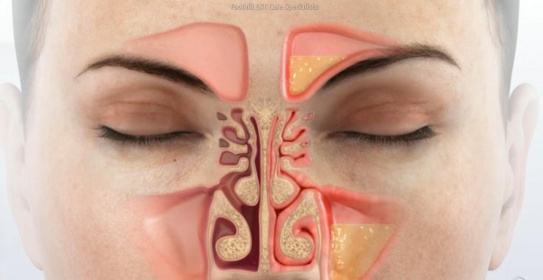 Что такое синусит симптомы и лечение Что такое синусит симптомы и лечение