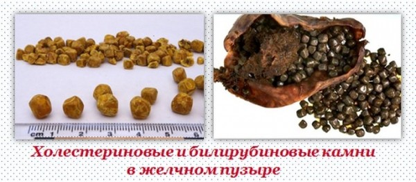 Холестериновые камни в желчном пузыре Холестериновые камни в желчном пузыре