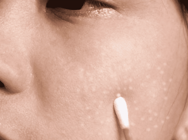 Как избавиться от жировиков на лице в домашних условиях? Как избавиться от жировиков на лице в домашних условиях?