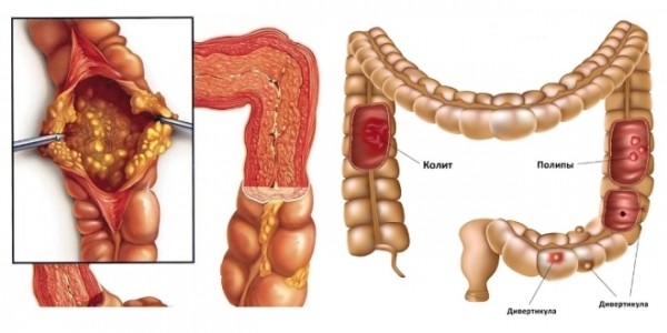 Лечение травами желудочно-кишечного тракта Лечение травами желудочно-кишечного тракта