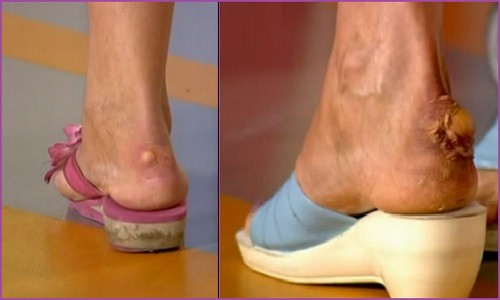 Можно ли прокалывать мозоли? Можно ли прокалывать мозоли?