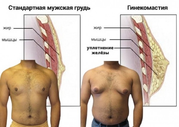 Мужчины также страдают от рака груди