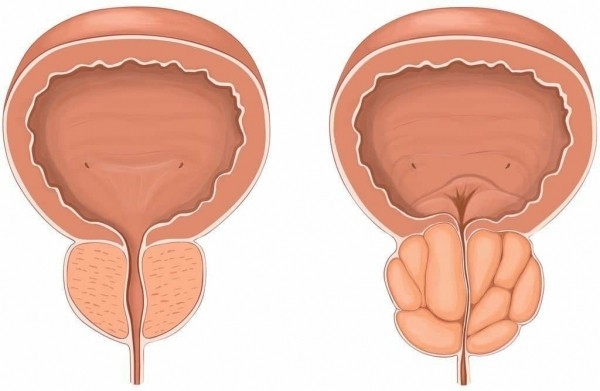 Недержание мочи при простатите у мужчин за 50 Недержание мочи при простатите у мужчин за 50