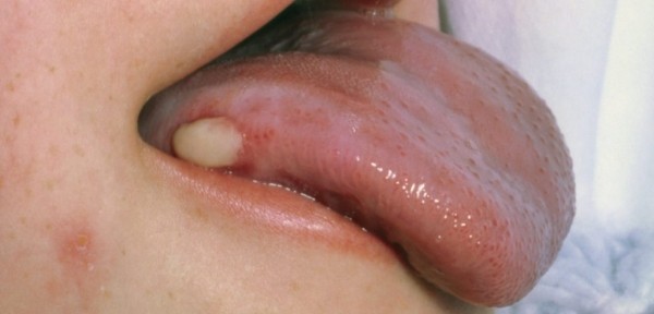 О чем сигнализирует раздутый язык О чем сигнализирует раздутый язык