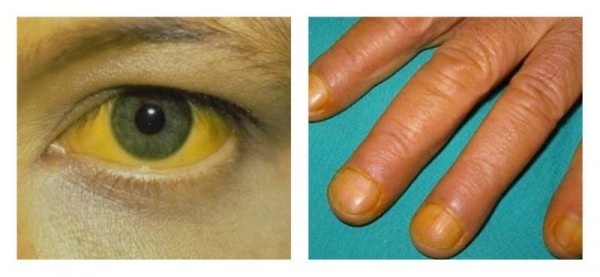 Первые симптомы рака поджелудочной железы Первые симптомы рака поджелудочной железы