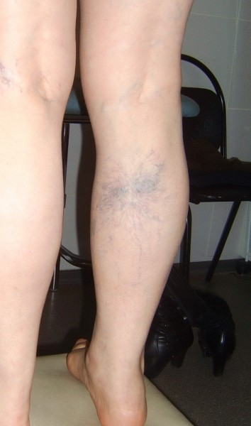 Варикозное расширение вен: причины и первые симптомы, почему к заболеванию склонны пожилые люди Варикозное расширение вен: причины и первые симптомы, почему к заболеванию склонны пожилые люди