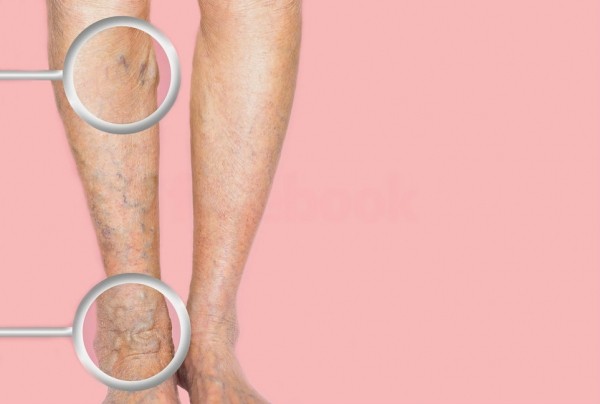 Варикозное расширение вен: причины и первые симптомы, почему к заболеванию склонны пожилые люди Варикозное расширение вен: причины и первые симптомы, почему к заболеванию склонны пожилые люди